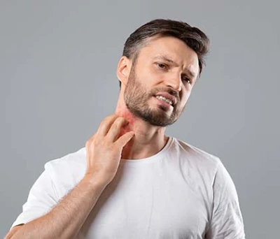 Hombre joven con dermatitis atópica sintiendo picazón y rascándose el cuello